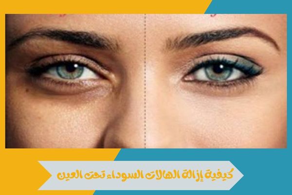 كيفية إزالة الهالات السوداء تحت العين في أسرع وقت 